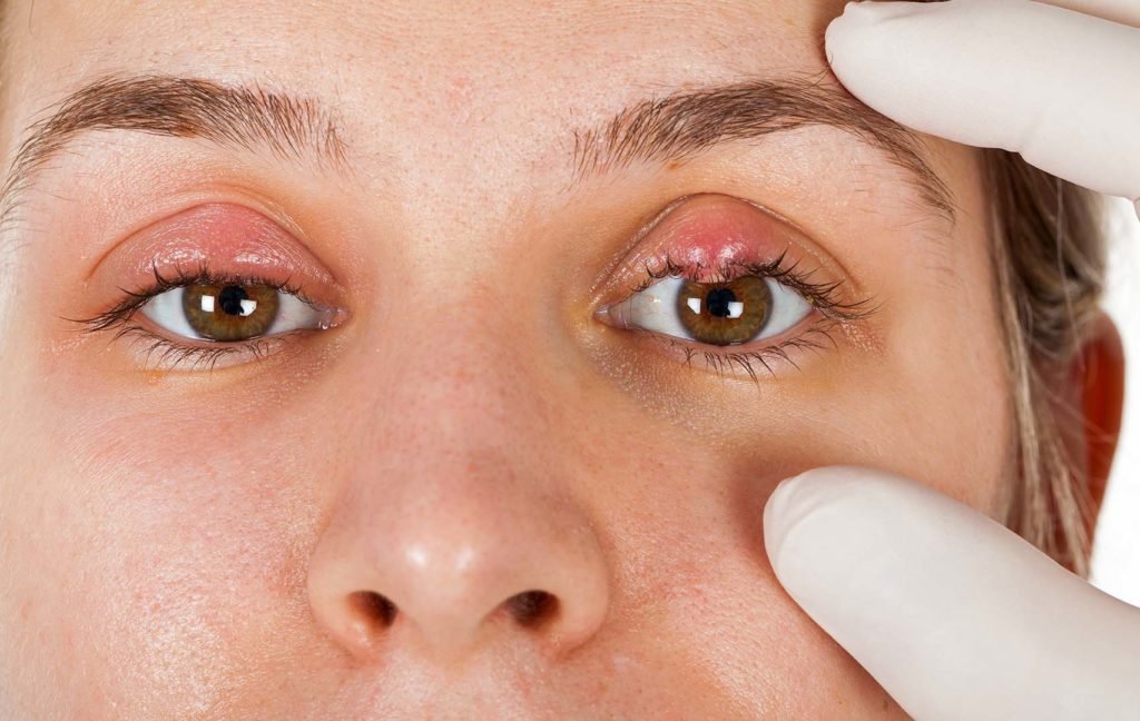 Terçol: o que é, existe prevenção e como tratar